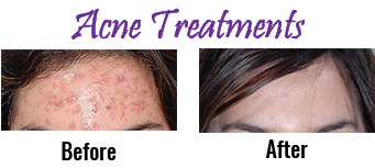 Cape Cod acne treatments