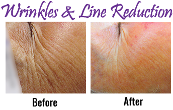 Wrinkle Reduction Cape Cod